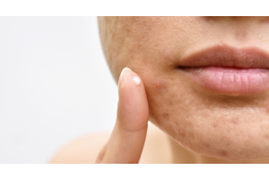 How to prevent and treat acne naturally?