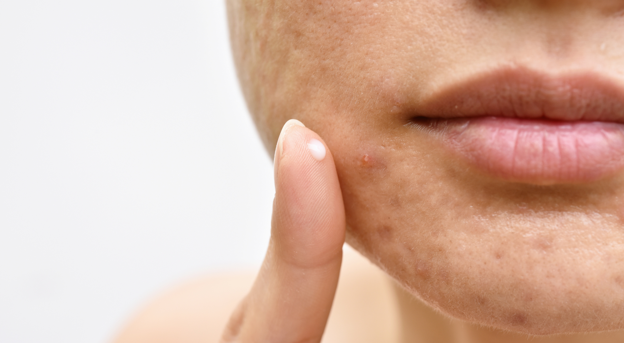 How to prevent and treat acne naturally?